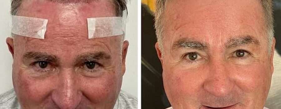 Former Sky Sports presenter Richard Keys enjoys astonishing hair transformation as he shows off progress of transplant which he had five months ago